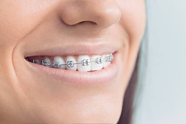 Best Veneers and Lumineers  in Alorton, IL